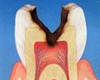 虫歯治療：根管治療